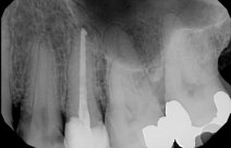 Root Canal and Endodontic Therapy